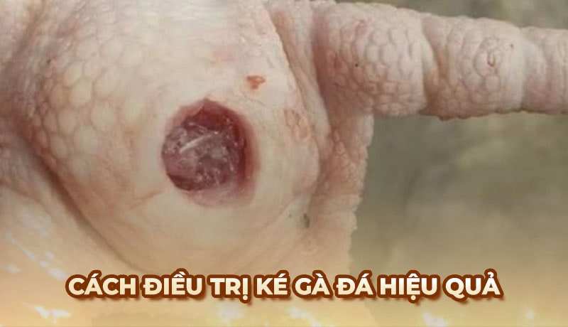 Điều trị ké gà đá: Cách nhận biết và chữa trị hiệu quả